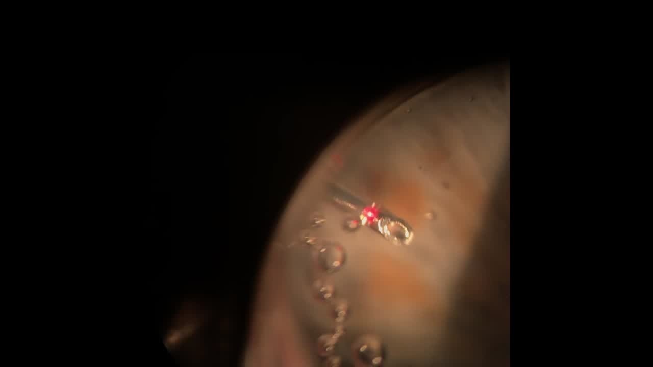 Mini-Shunt EX-PRESS Activation With Nd:YAG laser