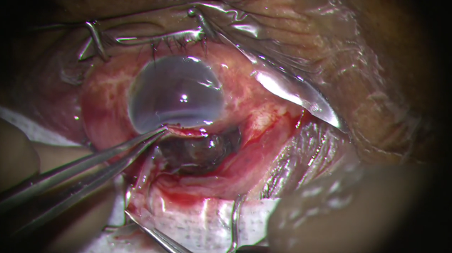 Traumatic Suprachoroidal Hemorrhage