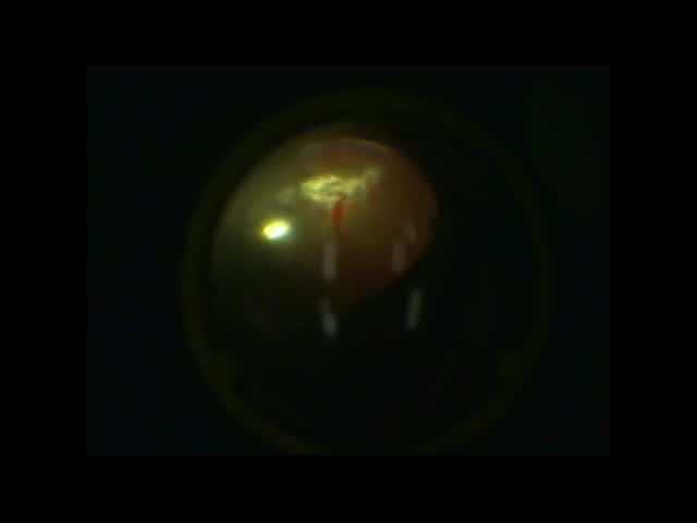 Inferior PVR: Membrane Peeling, Retinectomies, and Beyond