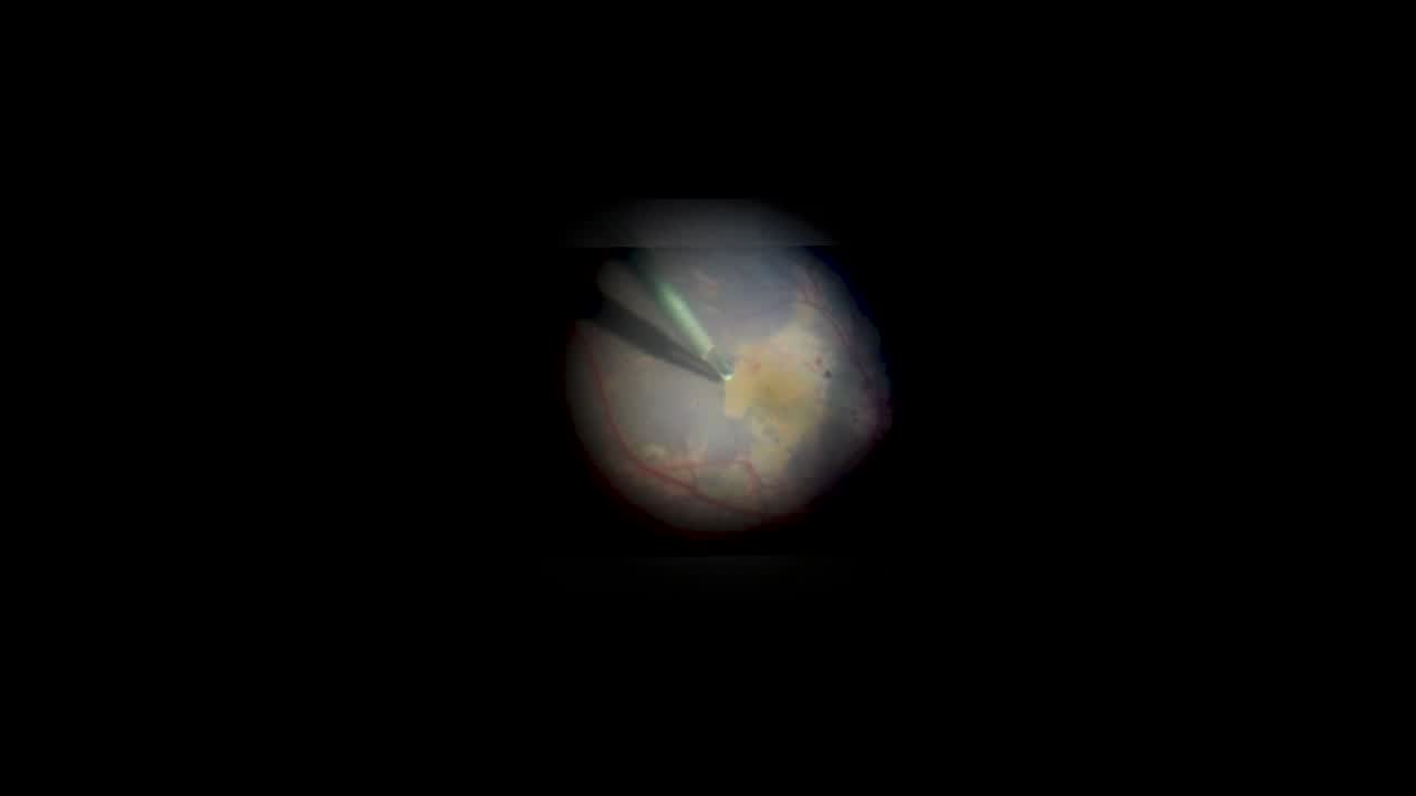 Pinhole Effect in Double Peel for Macular Hole