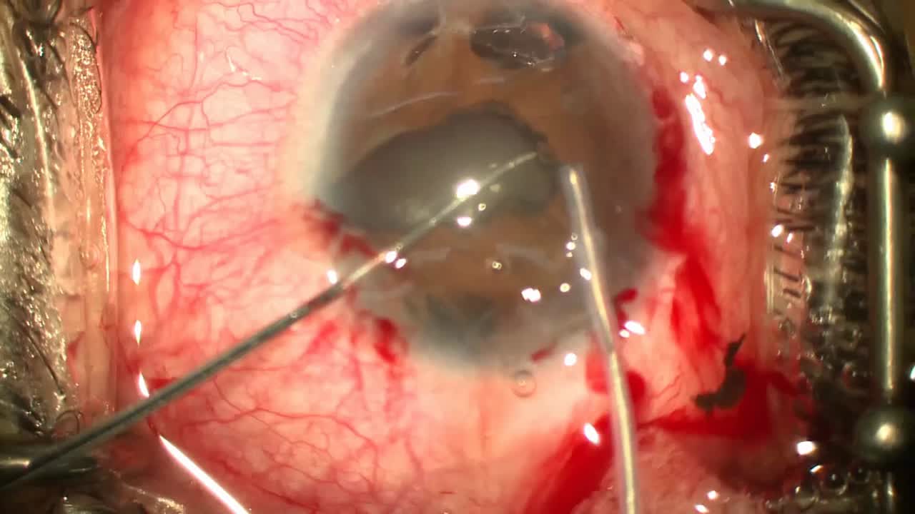 Viscocanalostomy and Pupilloplasty Using Fugo Blade in ICE Syndrome