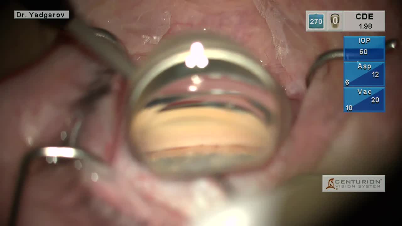 OMNI Surgical System (Sight Sciences): Procedure Pearls