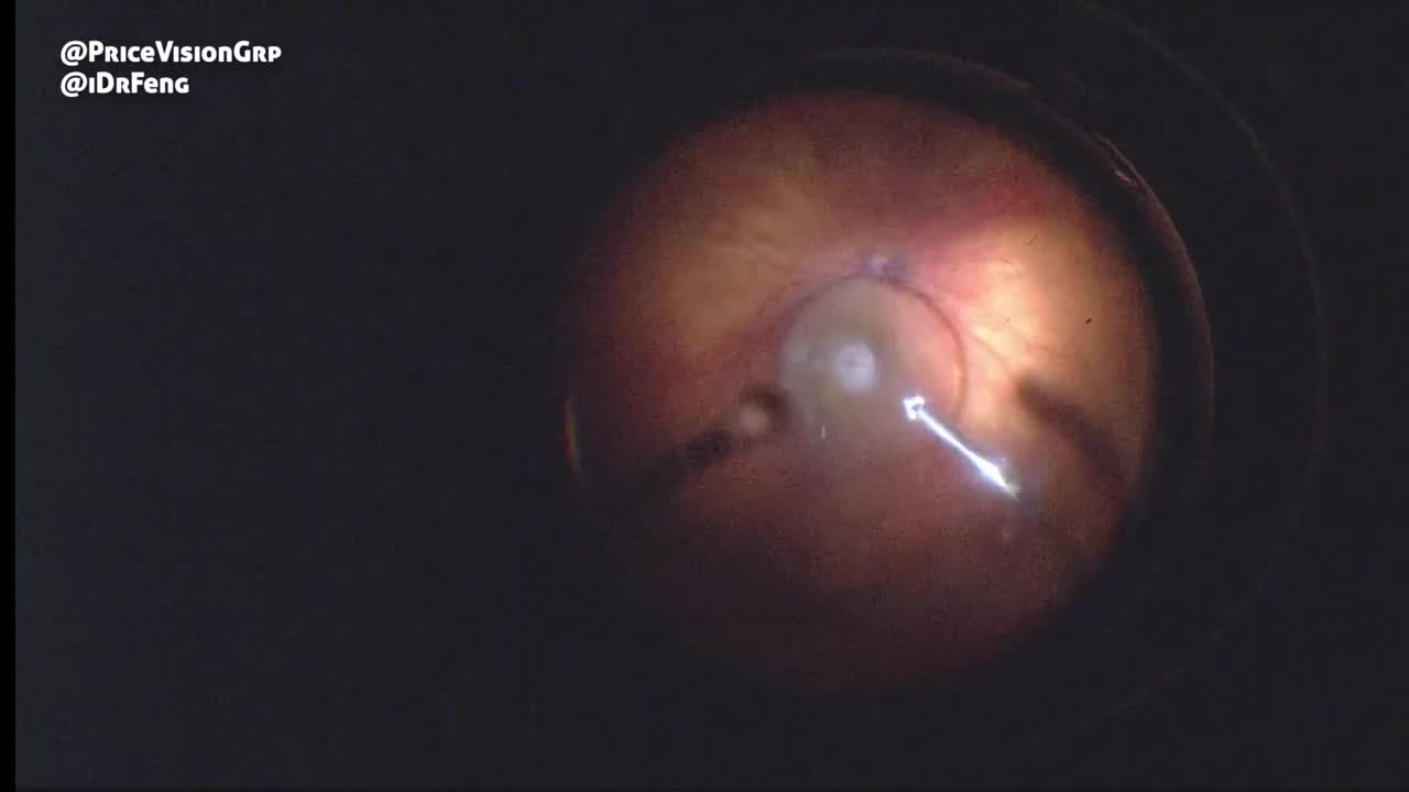 Dropped Posterior Polar Cataract