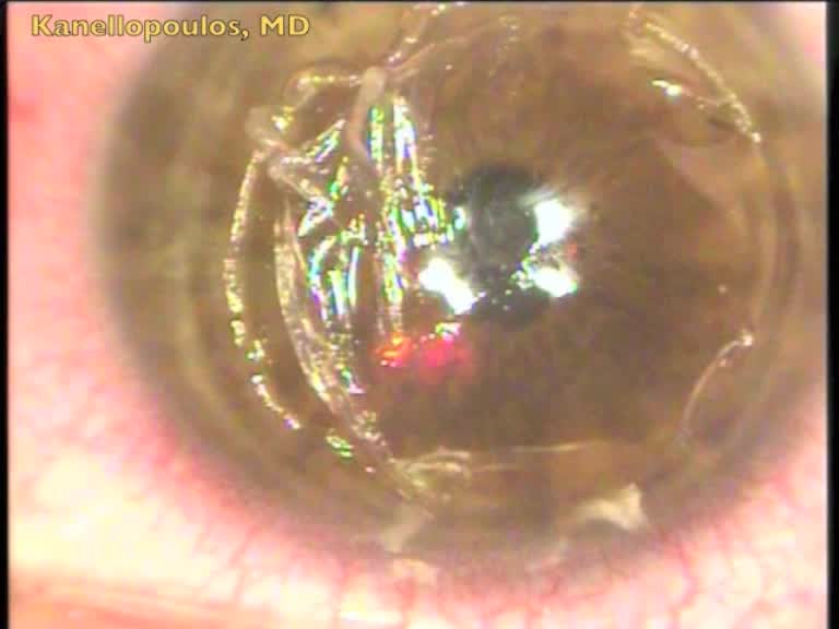 Extreme Lasik Epithelial Ingrowth Examples
