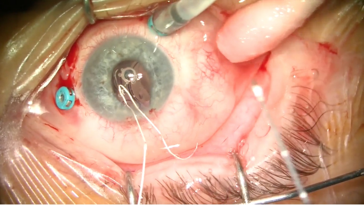 Refixation of a Dislocated Gortex Sutured Akreos IOL