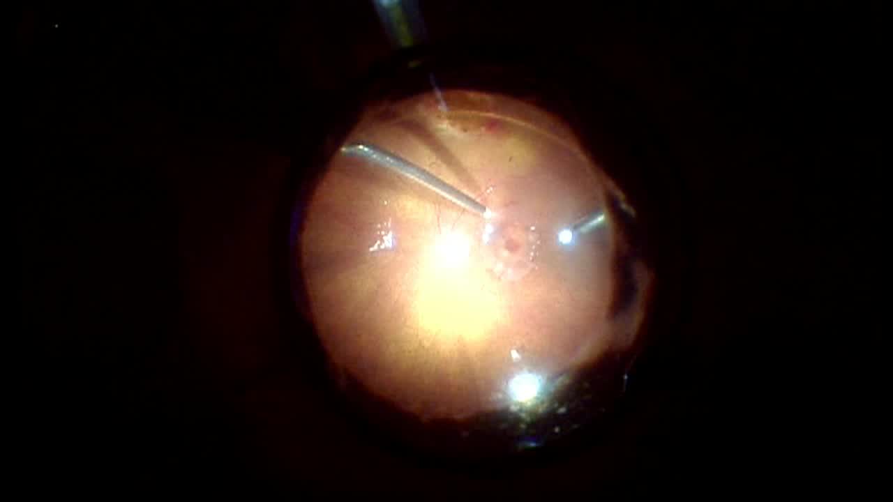 Autologous Retinal Graft for Chronic Macular Hole