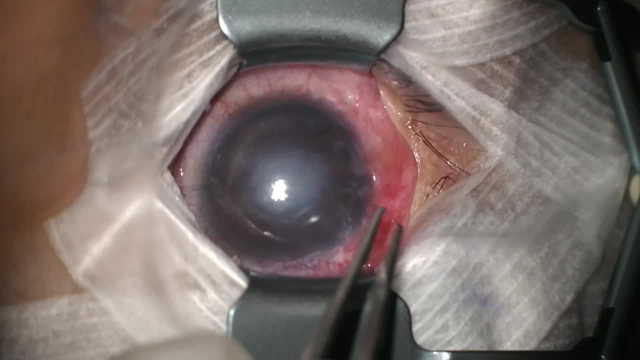 Tube-in-Tube Technique
