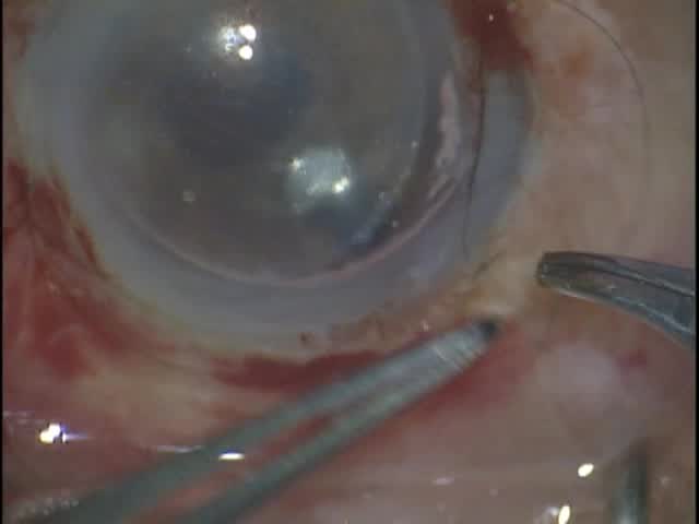 Anterior Chamber IOL Exchange and DSAEK Procedure With Pseudophakic Bullous Keratopathy