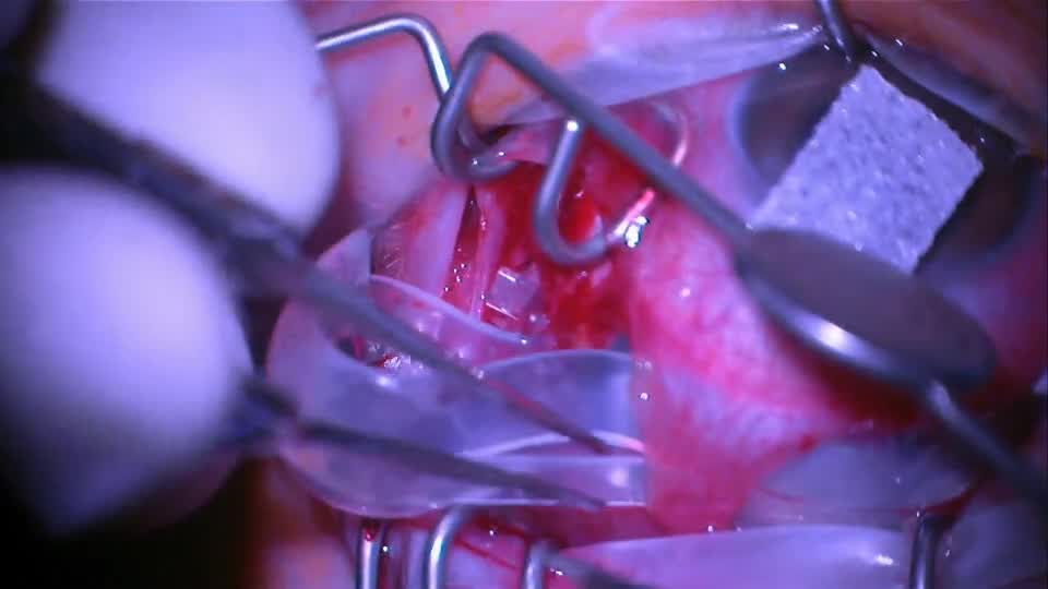 Exposed Scleral Buckle Removal With Small Incision