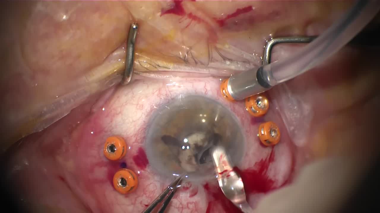 A Transconjunctival Approach
