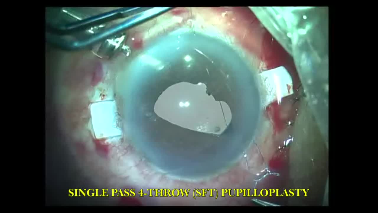 Subluxated Capsular Bag-IOL Complex with CTR and Single Pass 4-Throw Pupilloplasty