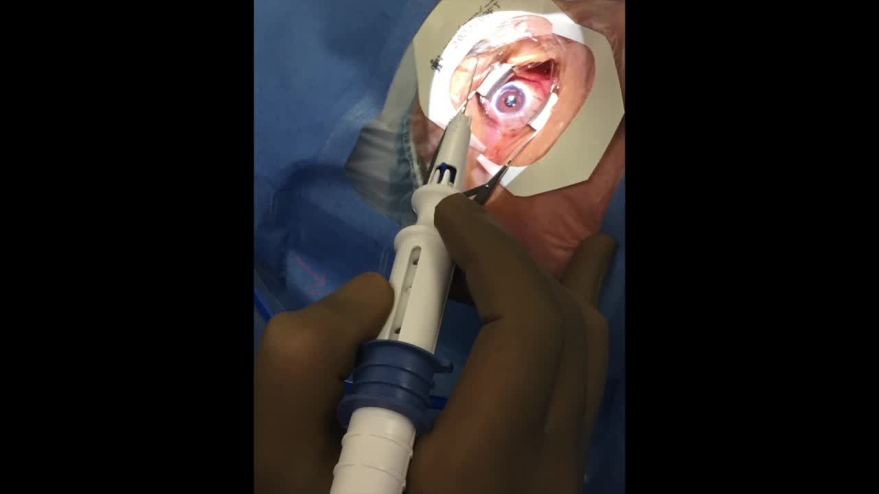 XEN Gel Stent Pearls for Success