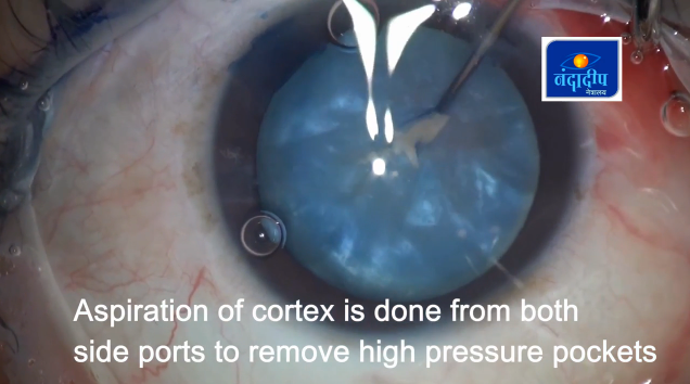 Stepwise Guide to Capsulorhexis in Intumescent Cataract