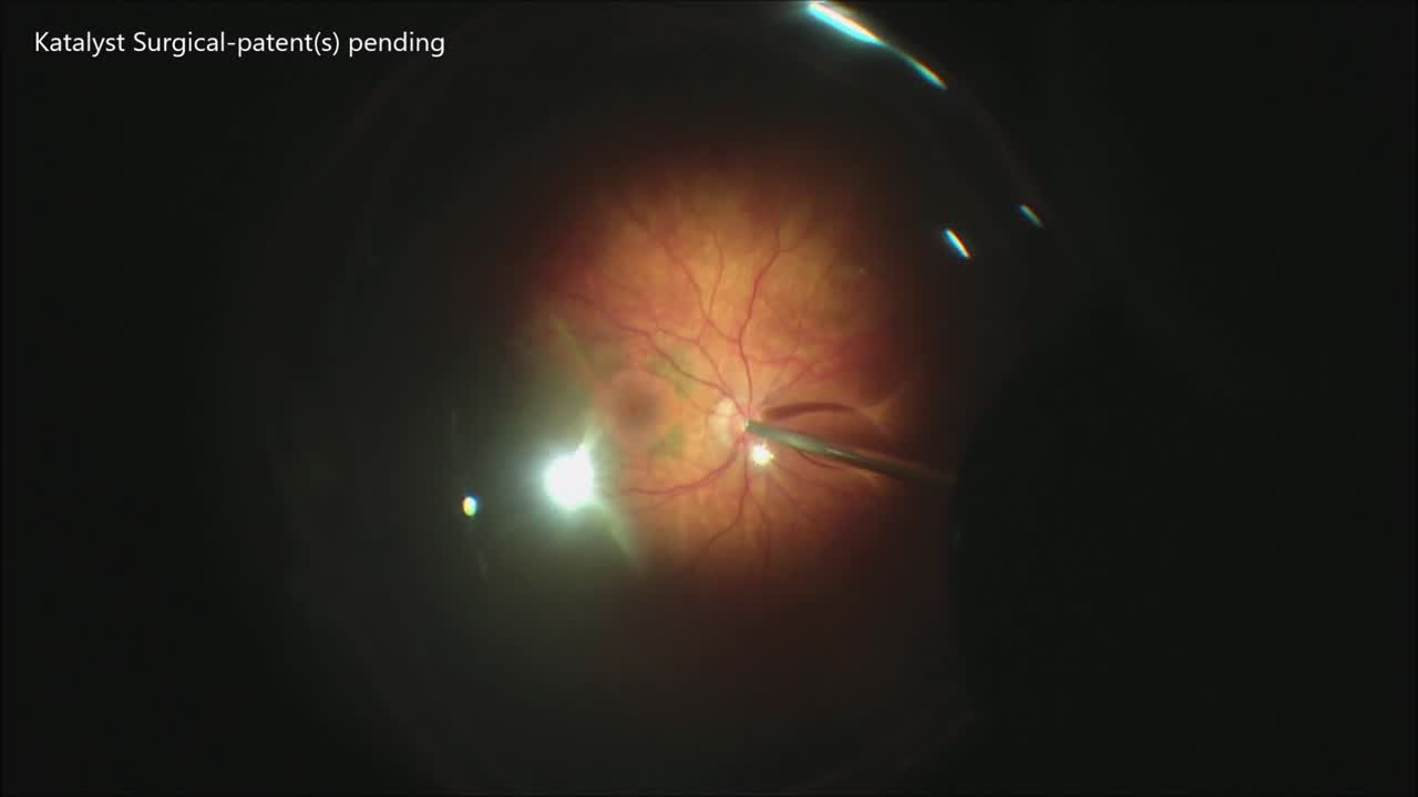 ILM Peeling for Macular Hole Using the Awh MVP