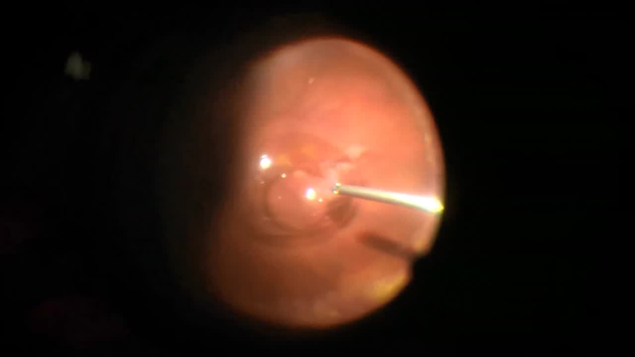 Anterior PVR with Recurrent Retinal Detachment, Hypotony, and IOL Dislocation