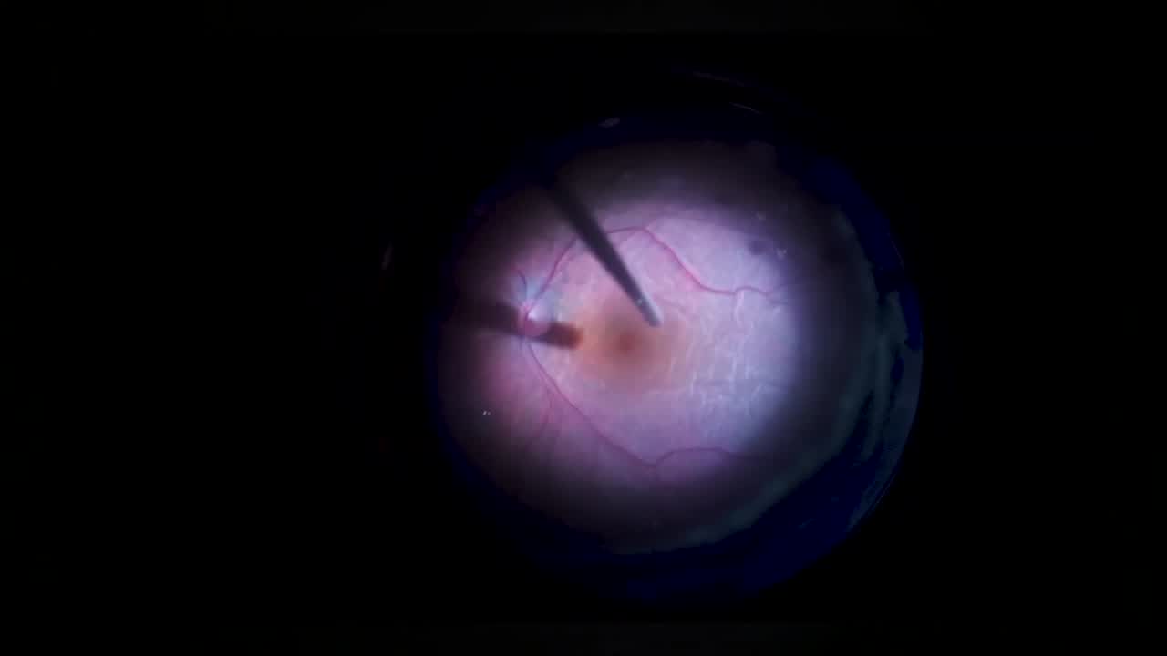 Buckle Vitrectomy With Peripheral Retinotomy for Retinal Shortening PVR and Silicon Oil