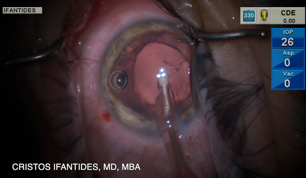 The Amazing Cataract Houdini