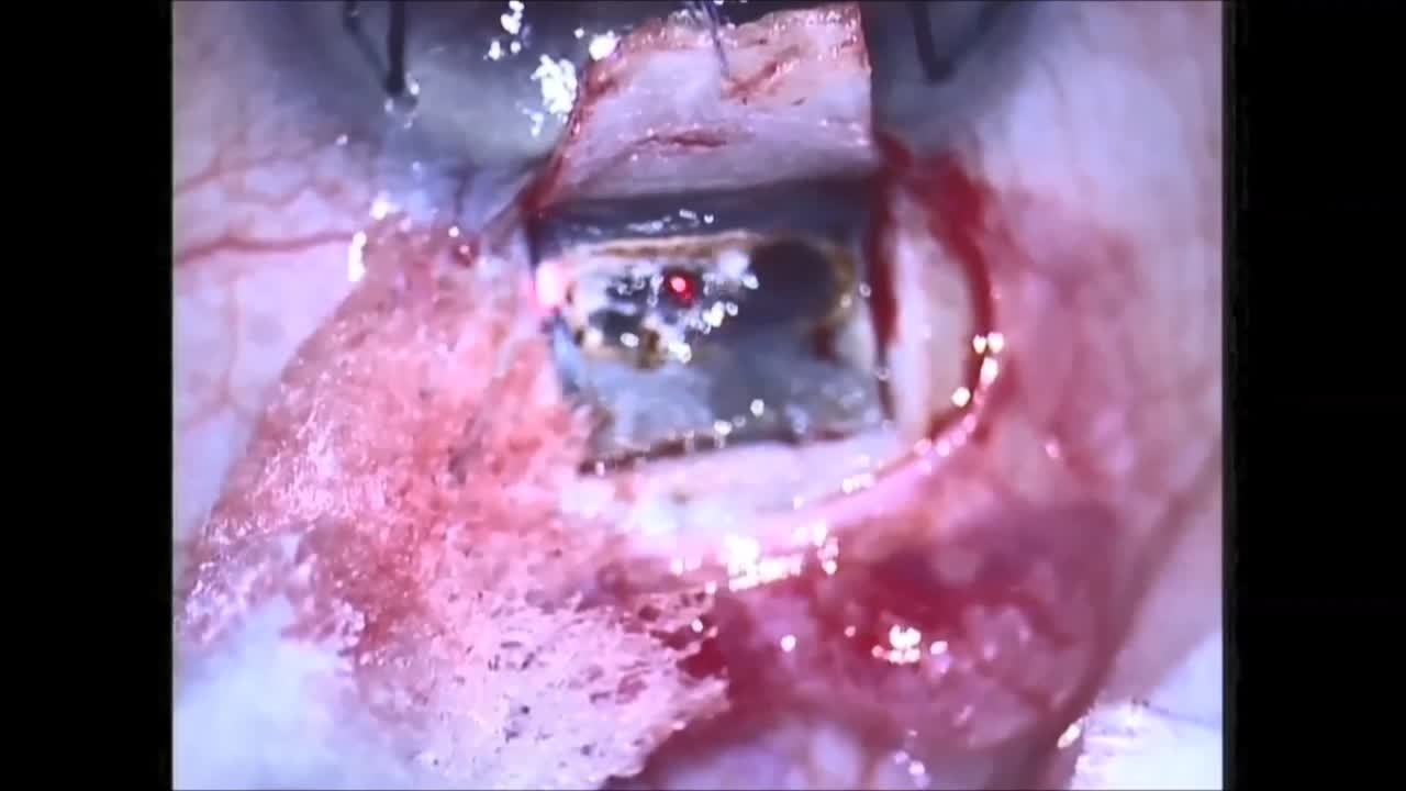 CO2: A New Tool for Non Penetrating Glaucoma Surgery