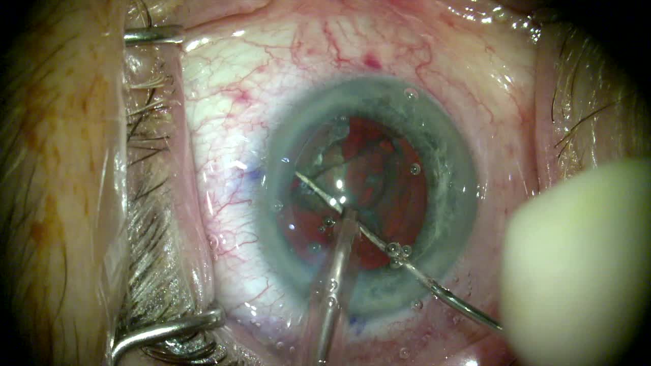 Preserving Capsular Integrity With FLACS
