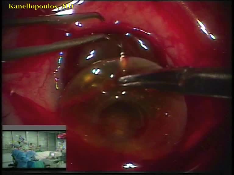 Keratoprosthesis With KeraKlear II Implant