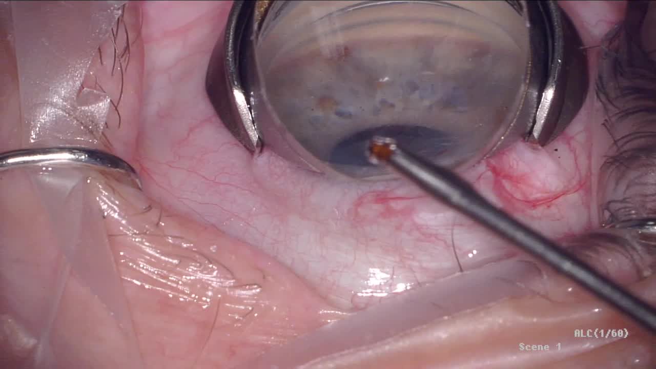 CyPass Trimming with MST Cutting Forceps