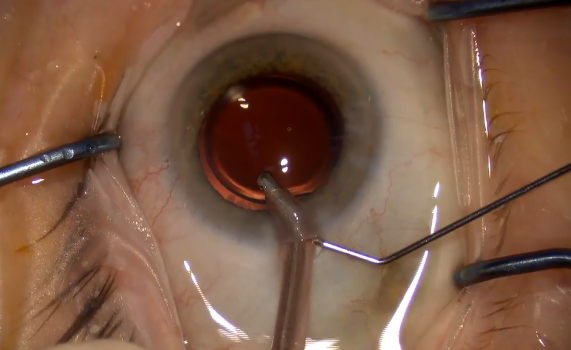 Preventing Iris Prolapse