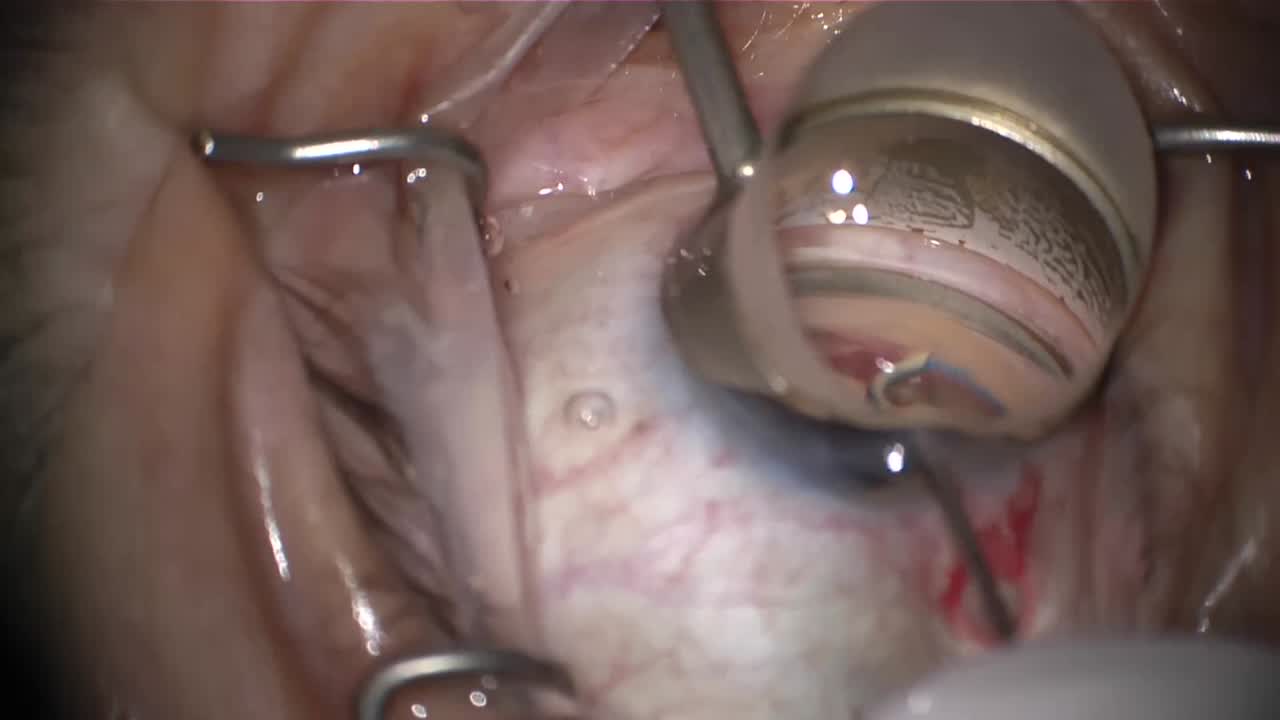 The OMNI Surgical System (Sight Sciences): Two Procedures in One