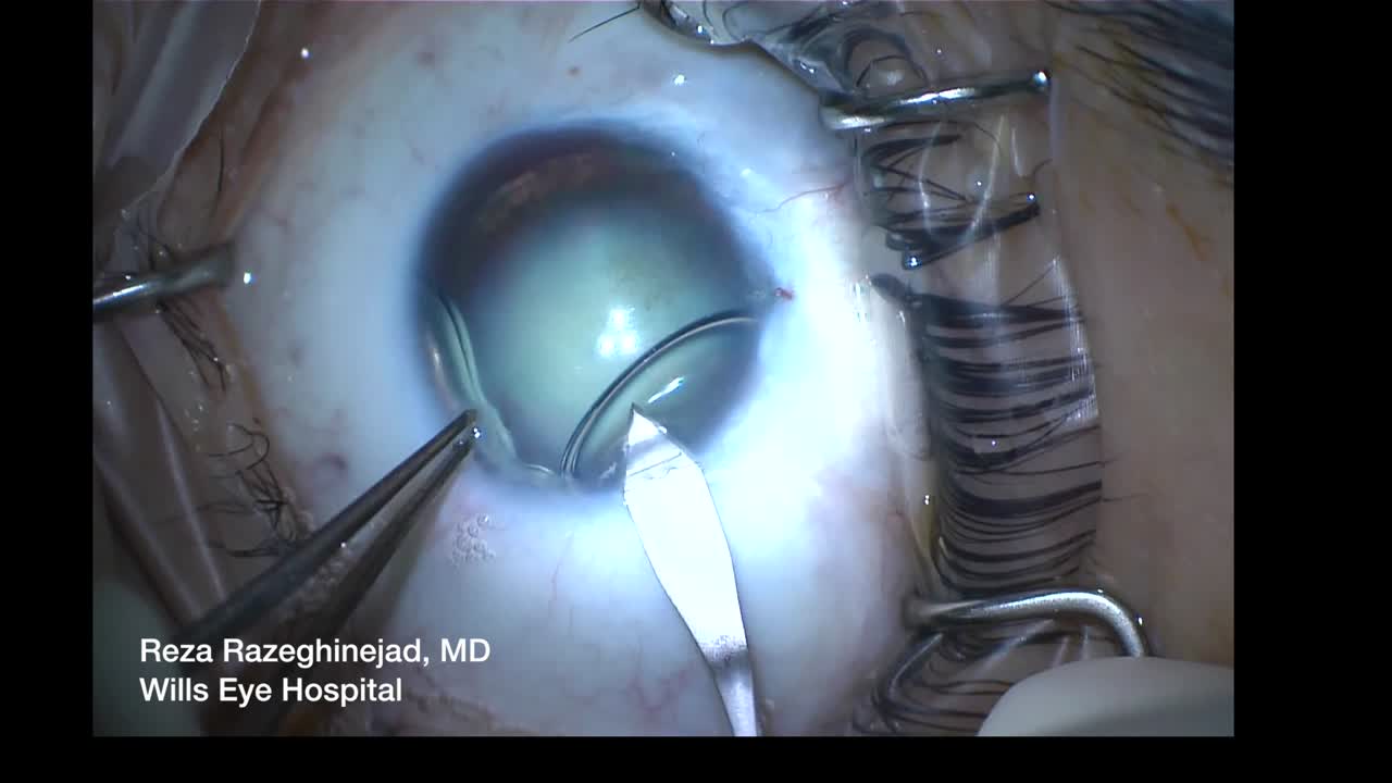 Cataract Surgery in Aniridia 