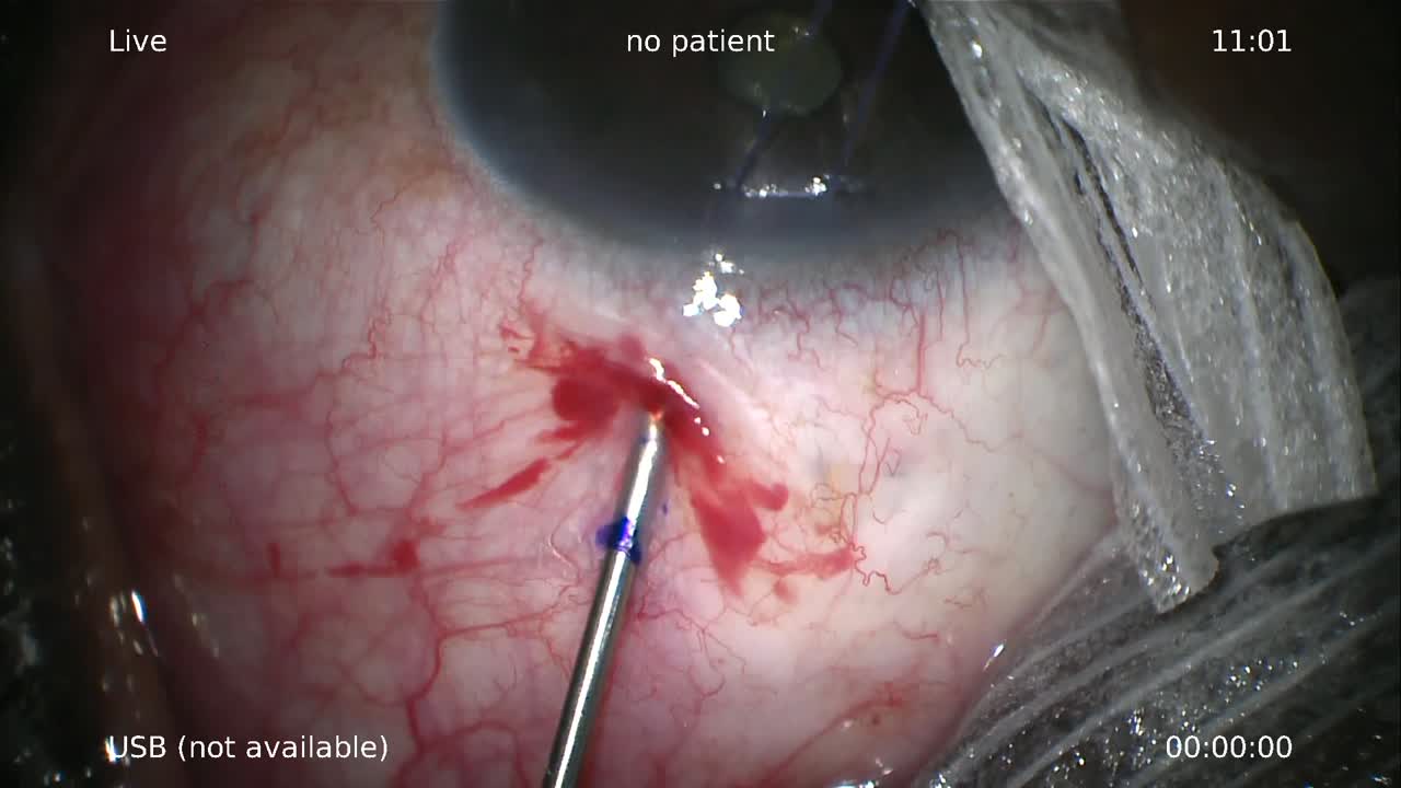 Xen 45 Gel Stent Implantation Ab Externo Without Conjunctival Dissection