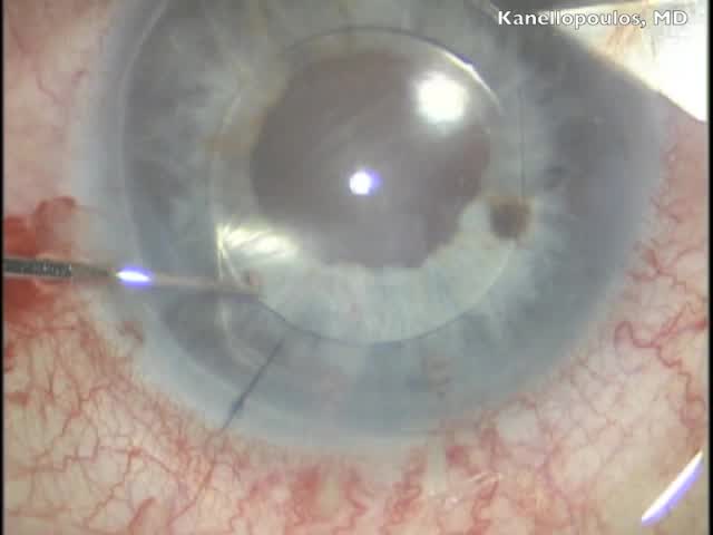 AC IOL Exchange in ARS With Combined IC IOL and AV