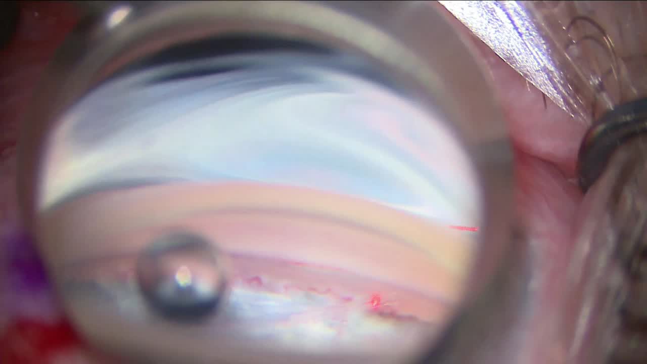 Ab Interno Canaloplasty ABIC Trabecular Meshwork Pull-Down Technique