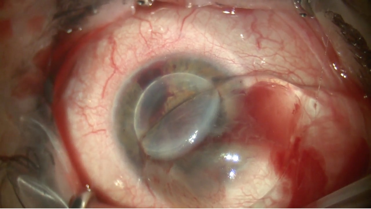 Management of Retinal Detachment After Expulsive Hemorrhage