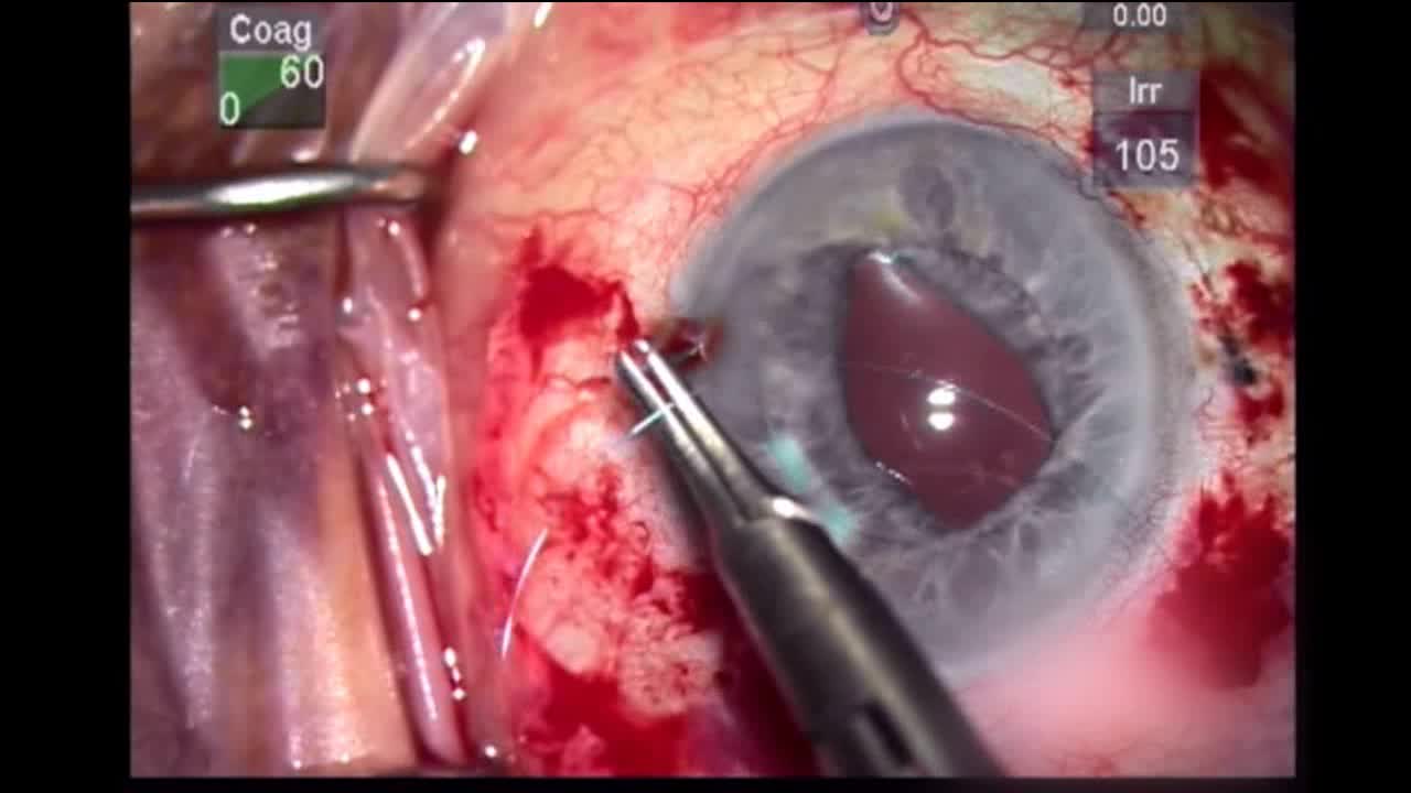 IOL Repositioning and UGH Syndrome