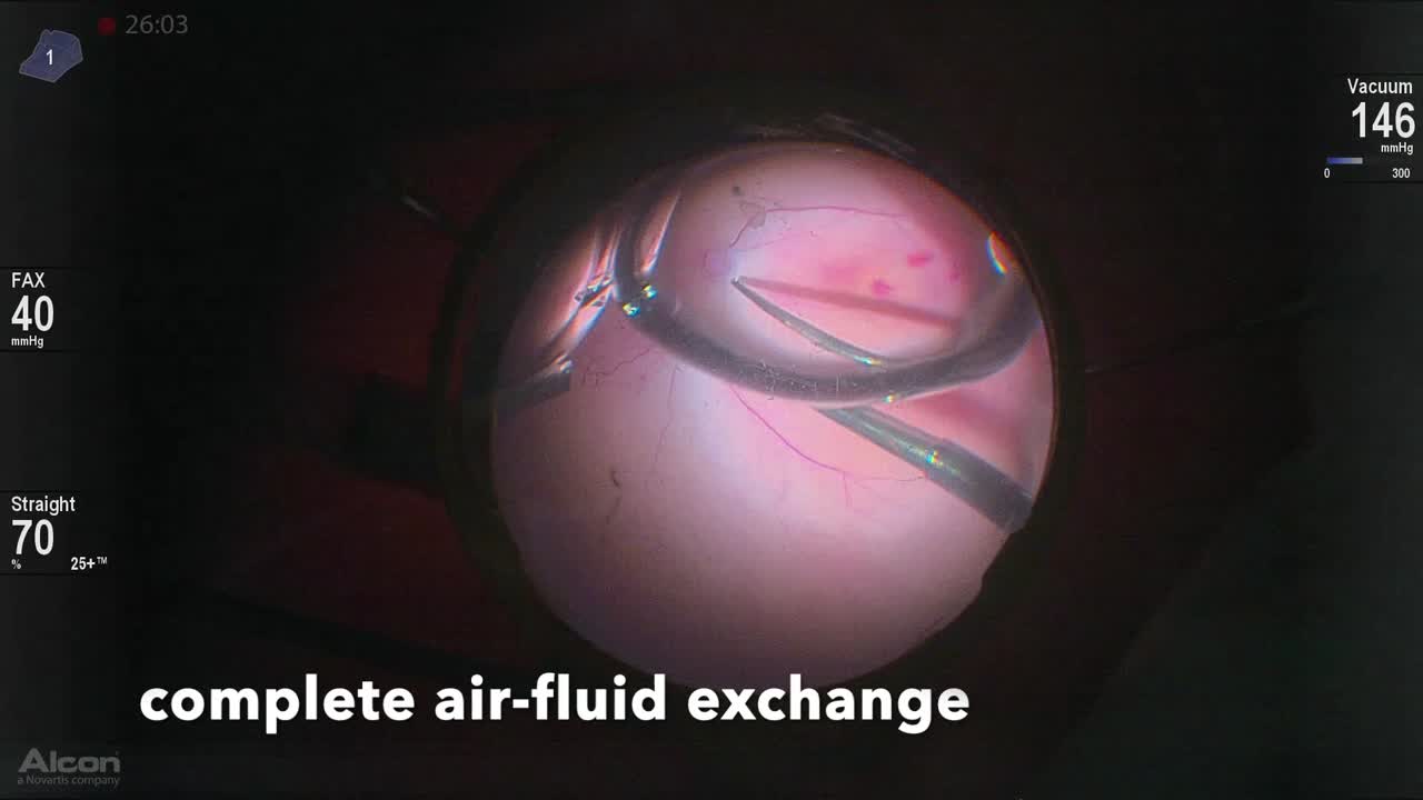 Retinopathy of Prematurity 4A Retinal Detachment