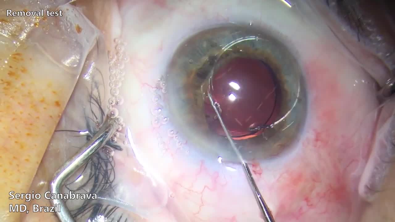 Canabrava Ring: 74 surgeries in 2 years