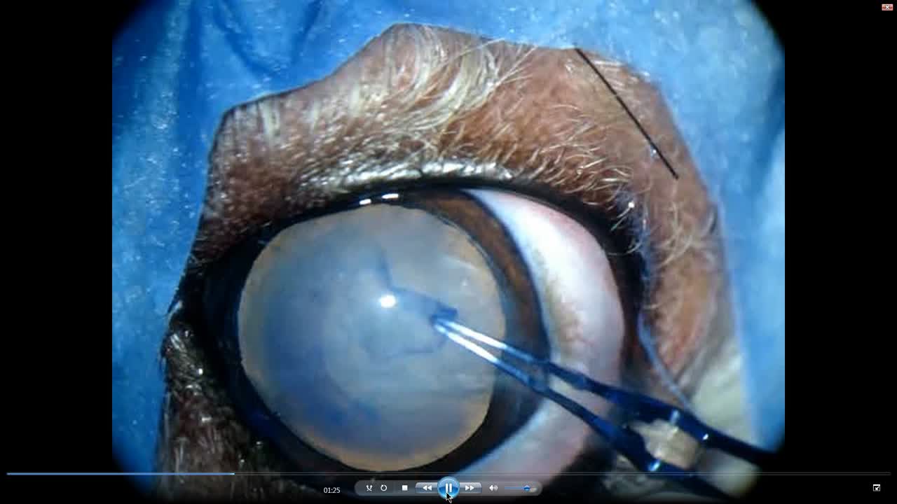Phacoemulsification in a Soft Nucleus