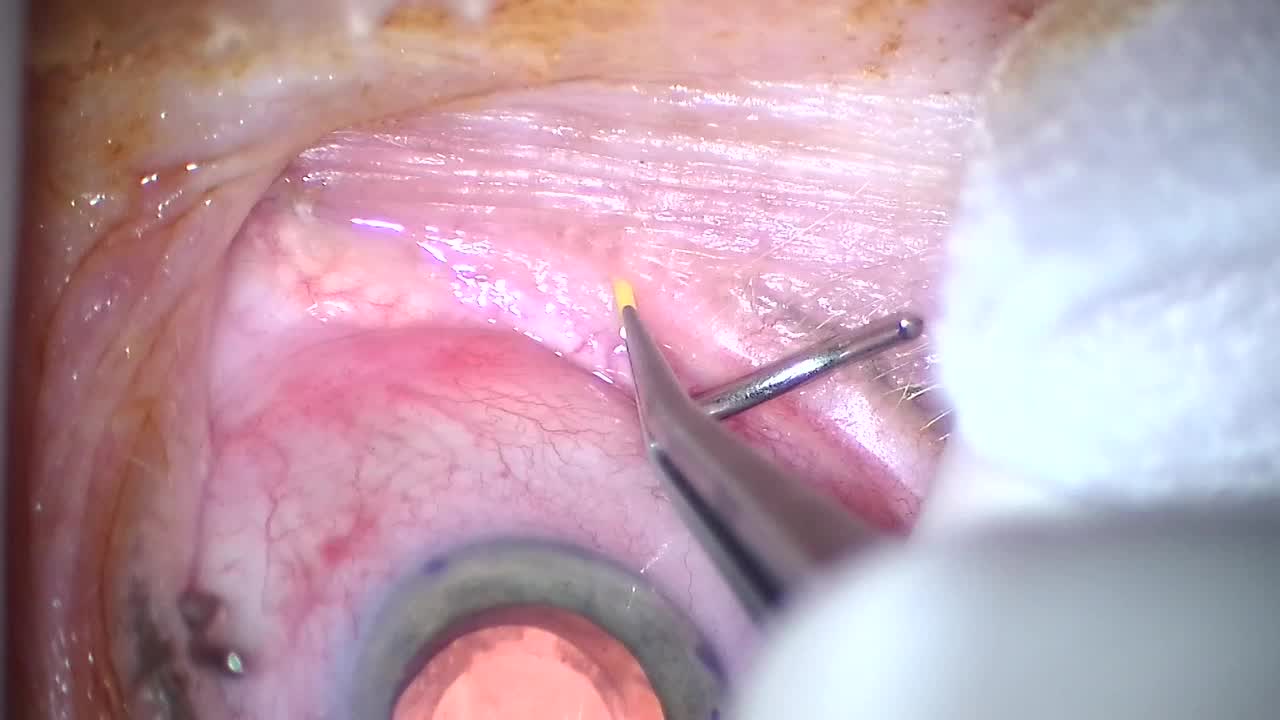 DEXTENZA: What Surgeons Need to Know