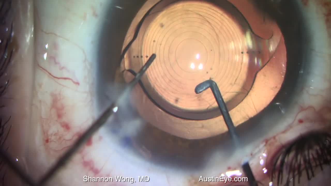 Symfony Toric Lens Placement with Posterior Capsular Tear and Posterior
