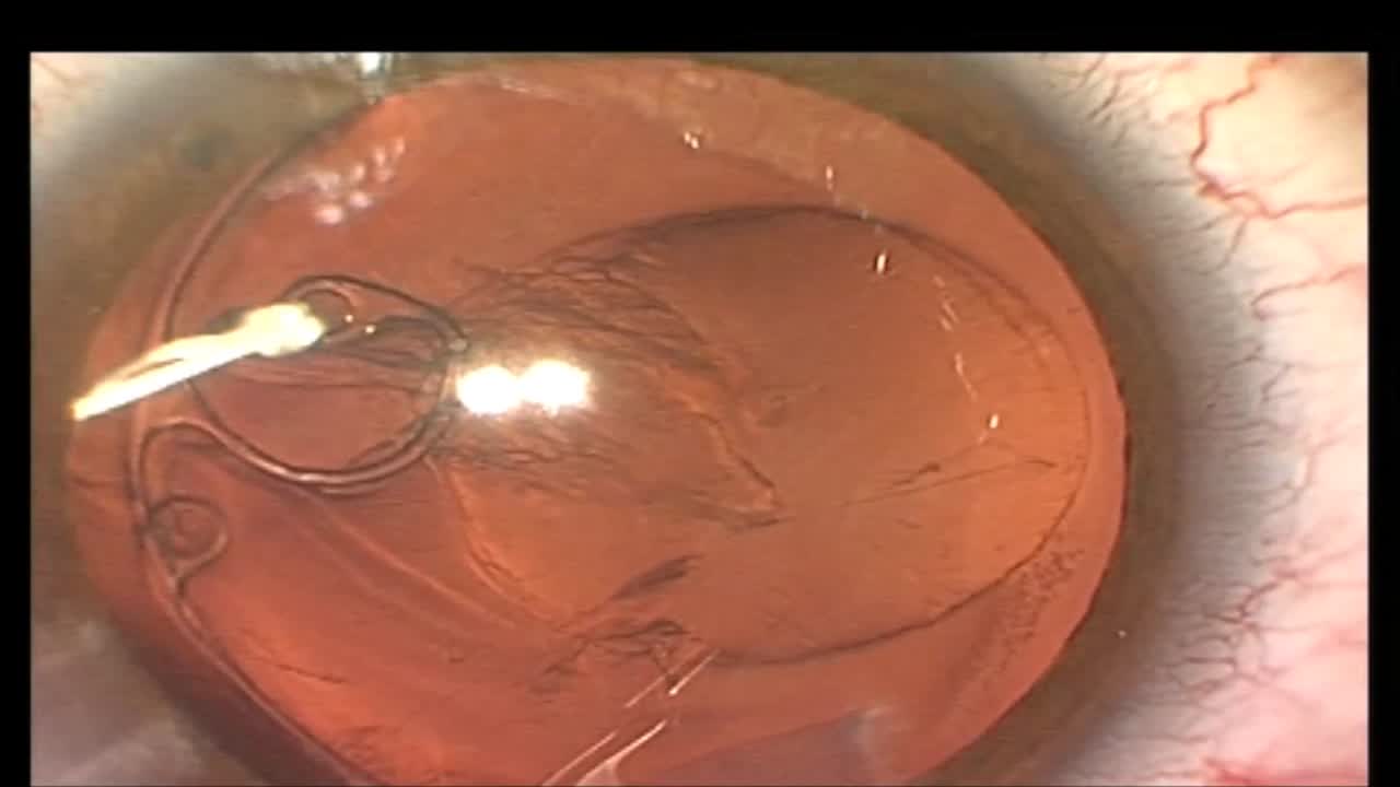 Scleral Fixated Cionni Capsular Tension Ring in Marfan Syndrome