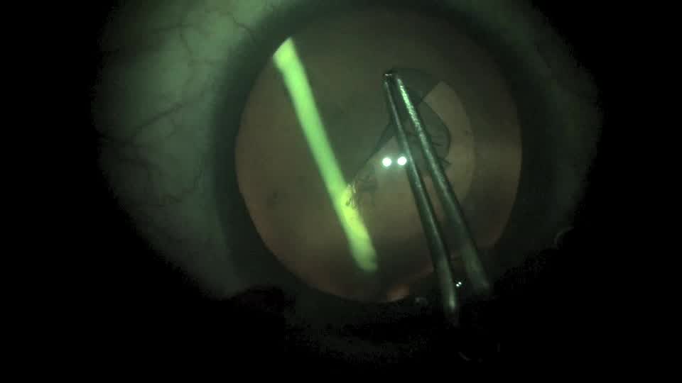 Phacoemulsification of an Ozurdex Implant in the Crystalline Lens