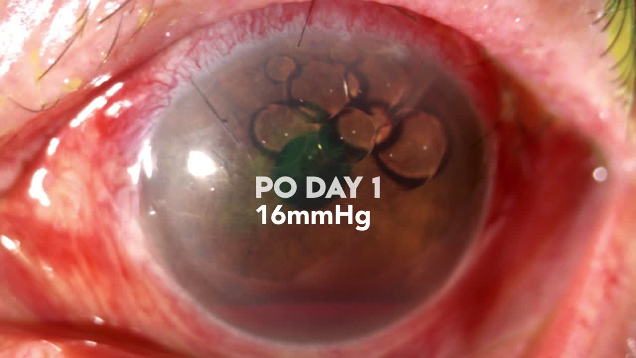 Recurrent Ahmed Tube Erosion: Surgical Management