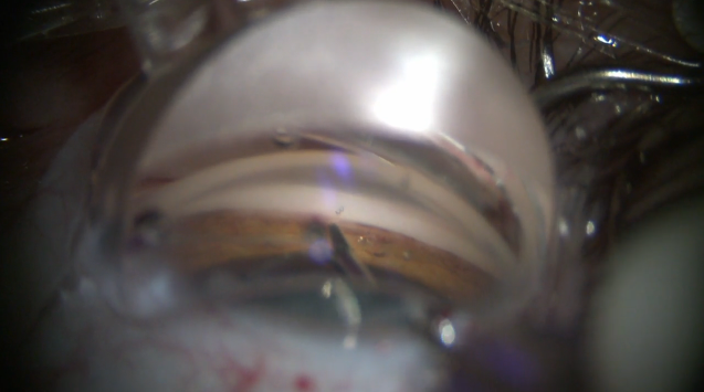 Clockwise iTrack Canaloplasty Catheter Insertion Technique