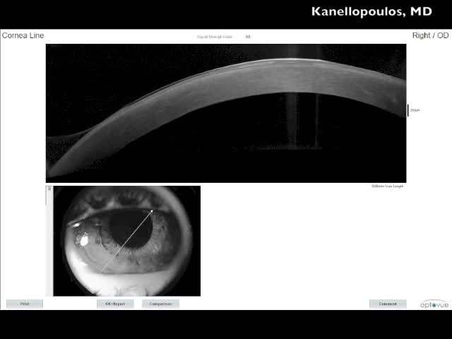 Combined PTK, PRK and CXL Procedure for Meesmann Corneal Dystrophy