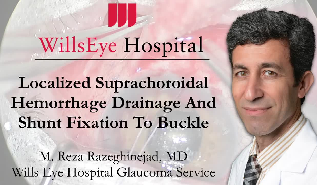 Localized Suprachoroidal Hemorrhage Drainage and Shunt Fixation to Buckle