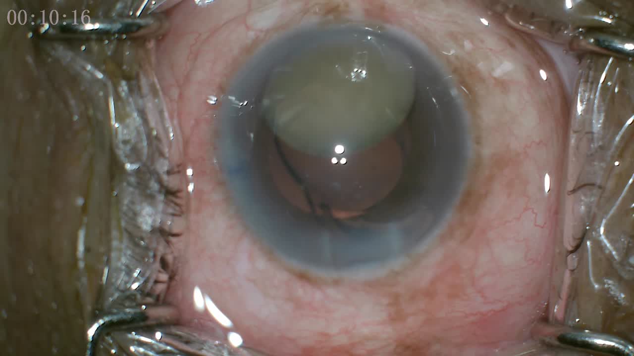 Hypermature Morgagnian Cataract