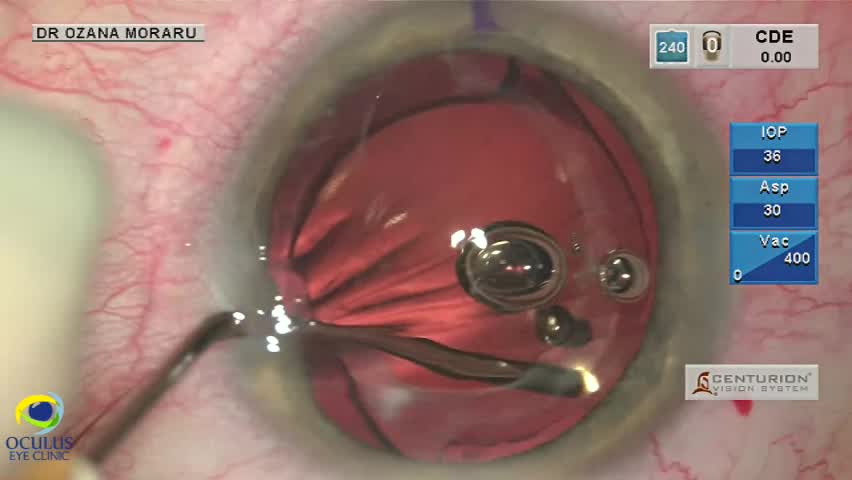 Managing Toric IOL Rotation and PCO in Late Capsular Bag Fibrosis