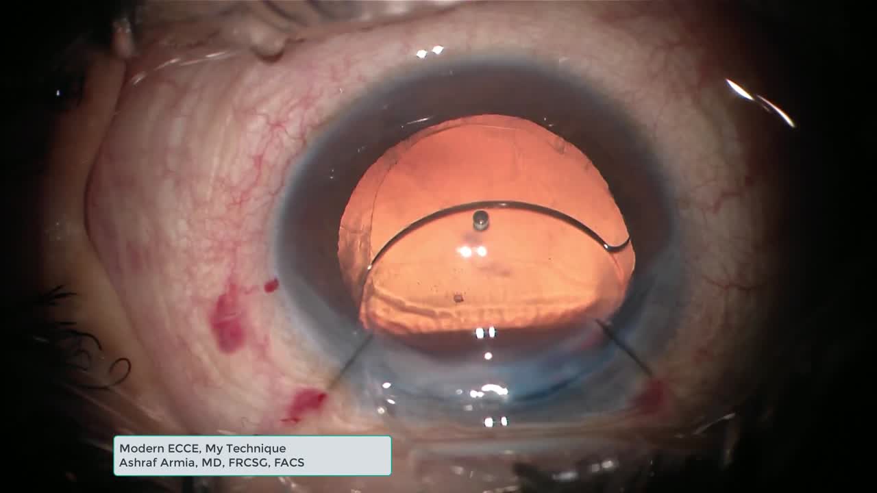 My Technique for Modern ECCE