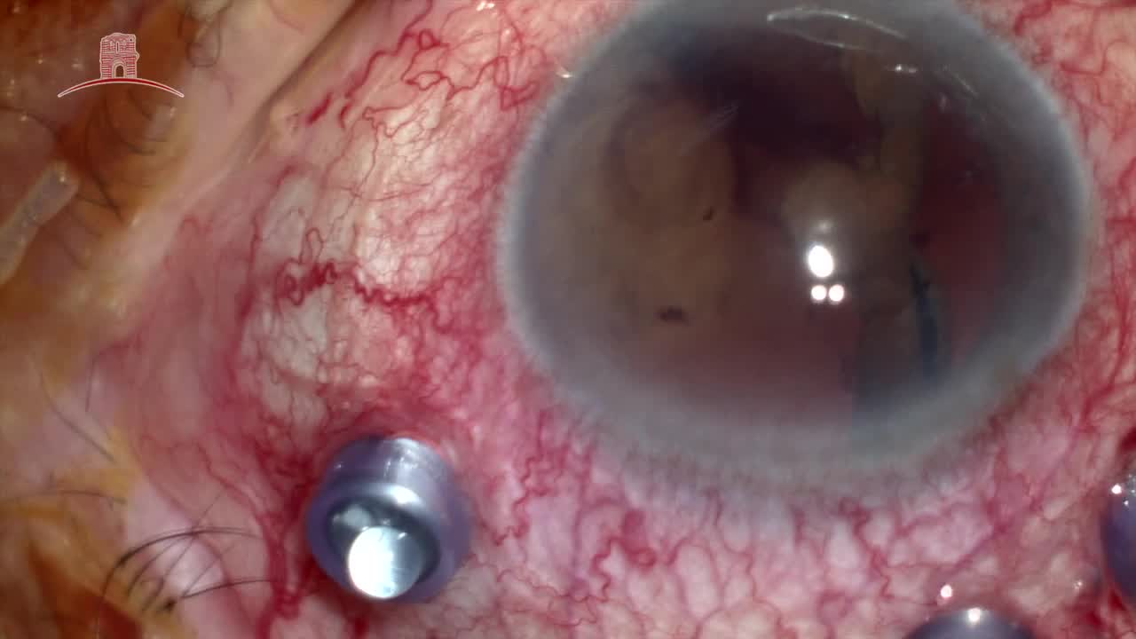 Triple Procedure 