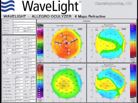 Cataract Extraction and Trifocal IOL PanOptix Implantation