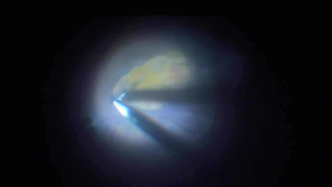 Taut ERM ILM Peel Technique